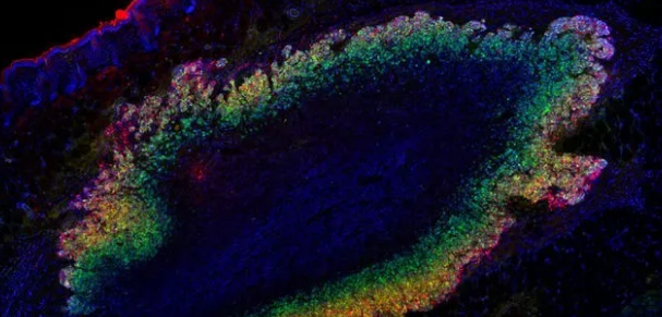 Science大发现：超声波“看”到肿瘤细胞打开了基因...