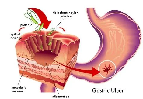 13C UBT Diagnostic Analyzer For H.pylori Infection