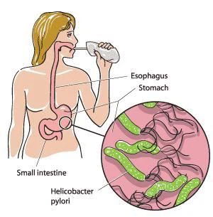 Medical Provider 13C Urea Breath H.pylori Testing Device