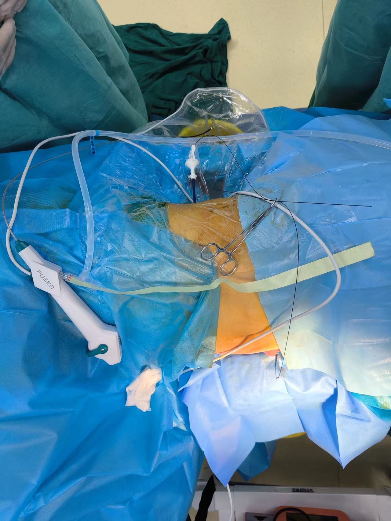 武汉同济航天城医院开展国内首例温控记忆合金输尿管支架治疗输尿管-回肠吻合口狭窄 武汉同济航天城医院开展国内首例温控记忆合金输尿管支架治疗输尿管-回肠吻合口狭窄