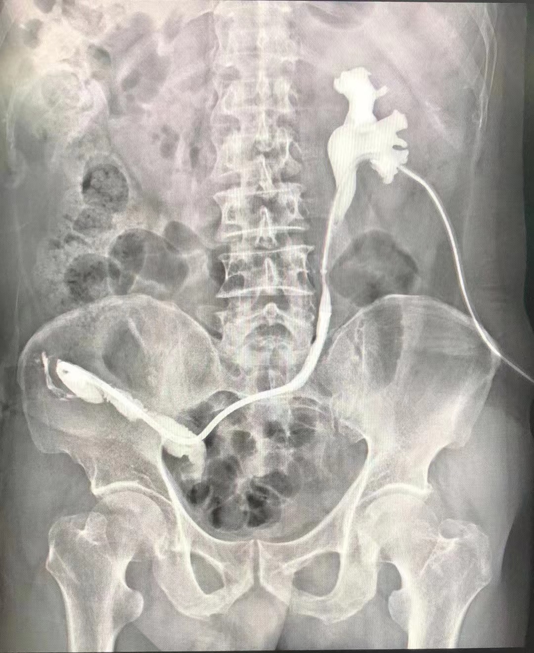 武汉同济航天城医院开展国内首例温控记忆合金输尿管支架治疗输尿管-回肠吻合口狭窄 武汉同济航天城医院开展国内首例温控记忆合金输尿管支架治疗输尿管-回肠吻合口狭窄