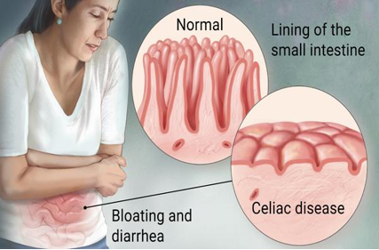 Characterization of neutralizing antibodies of broad spectrum glutenopeptide HLA-DQ2.5 complex