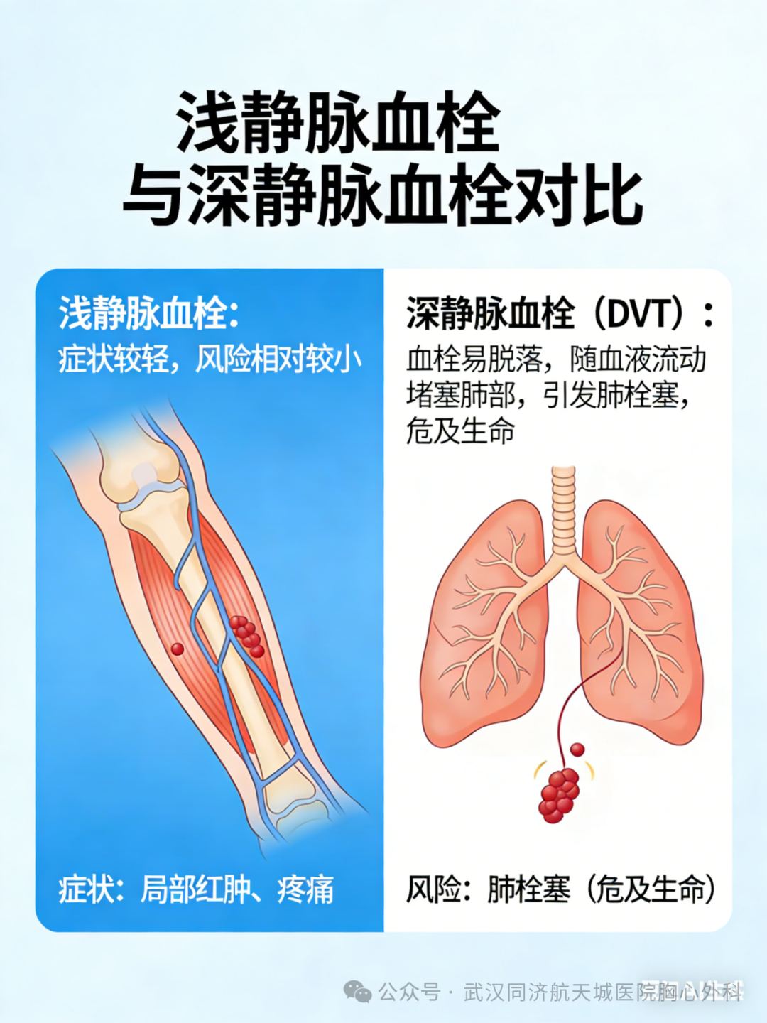 警惕 “沉默的杀手”！下肢深静脉血栓，这些人群一定要当心！